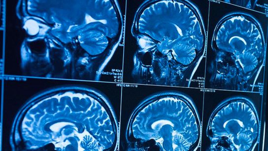 Study: CTE found in people with no history of contact sports (d)
